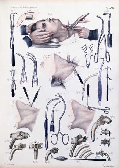 気管切開手術、ジャンバティストマルクブールジュリー（1797-1849）1866-67による「Traite Complet de l&39;Anatomie de l&39;Homme」のプレート 作： E. Pochet